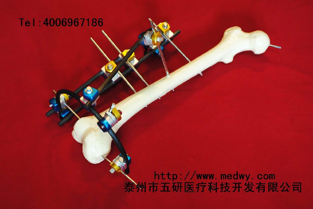 骨折、關(guān)節(jié)炎與四肢畸形患者福音