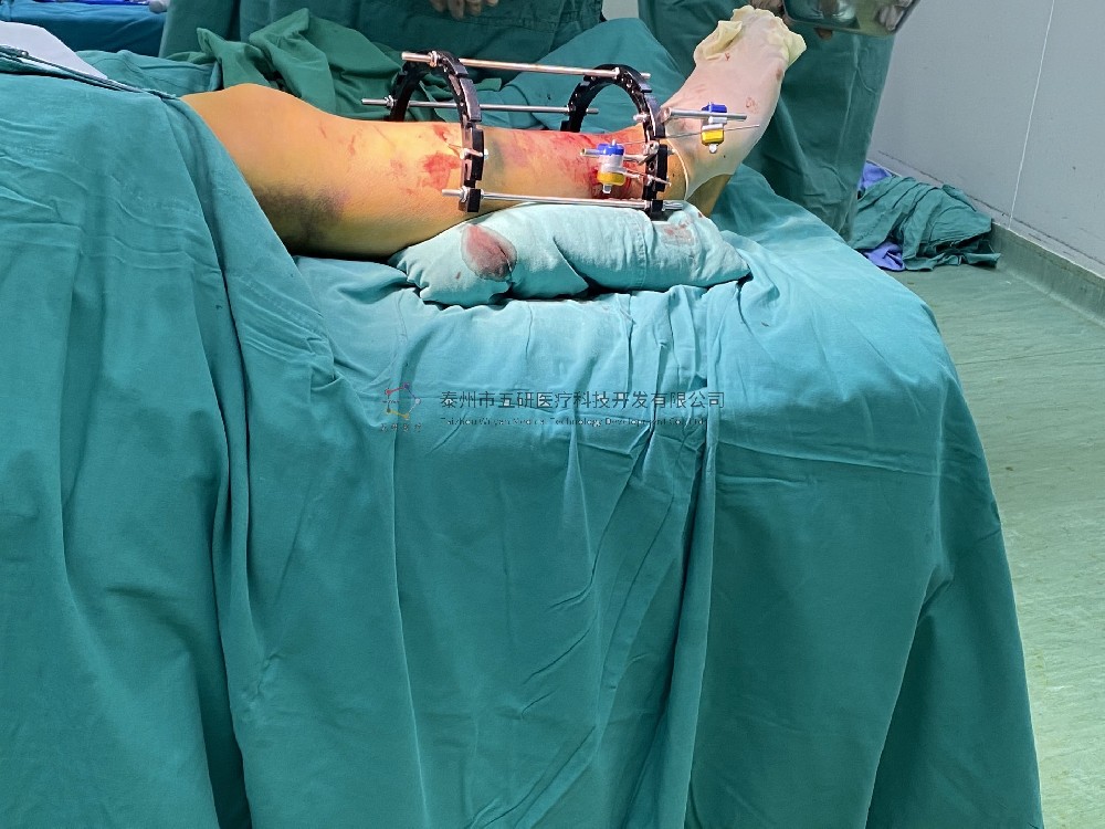 【望京醫(yī)院】不開(kāi)刀治骨折病例分享——下肢骨折